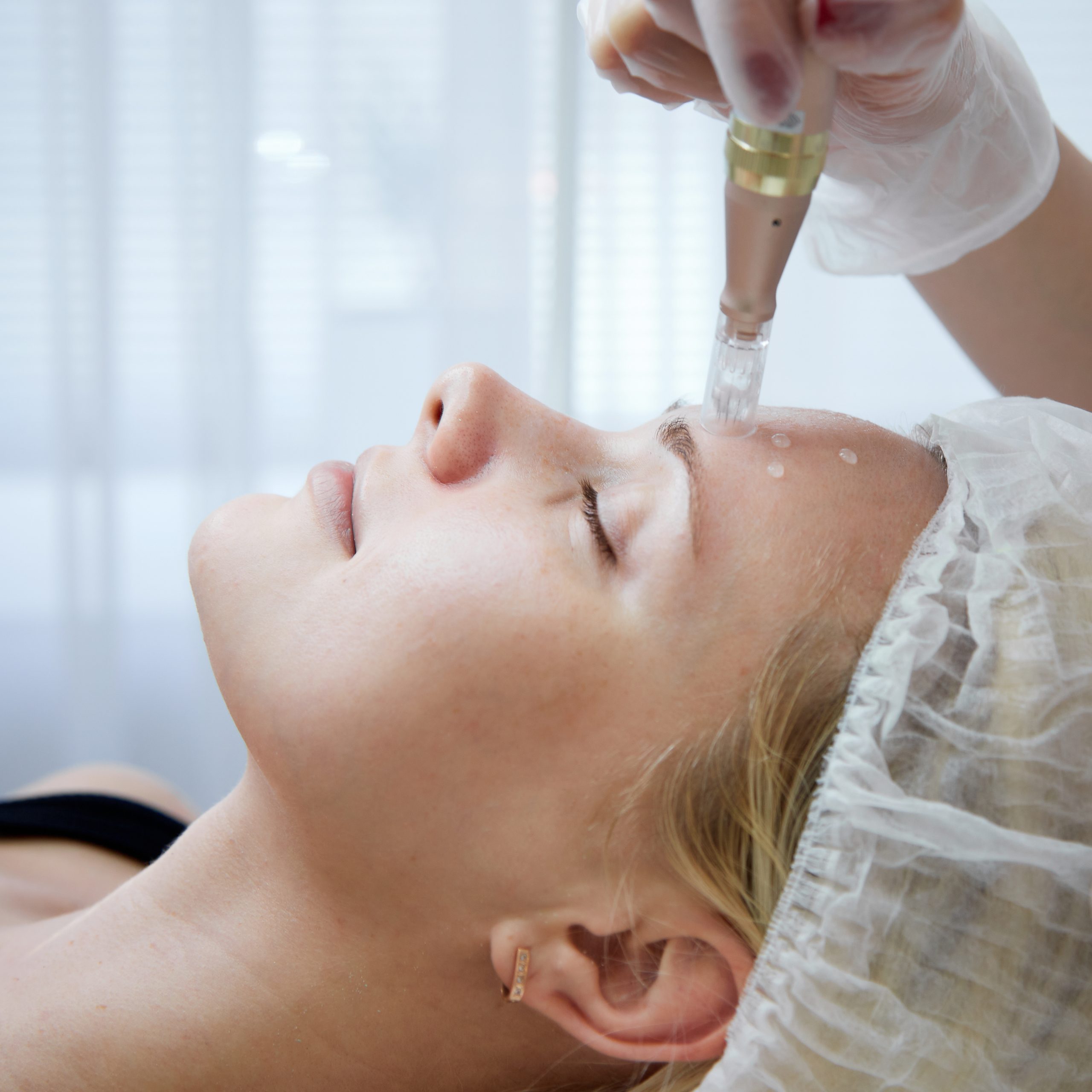 Microneedling